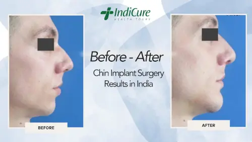 Chin Implant Surgery Results in India